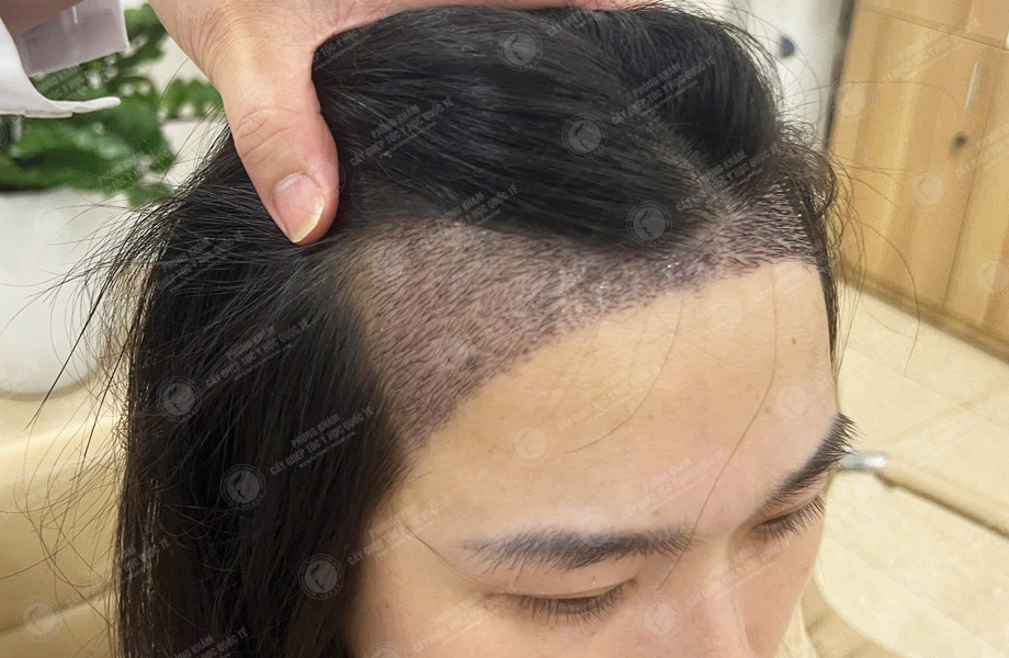 Lê Thị Nhi - Cấy tóc đường chữ M 5
