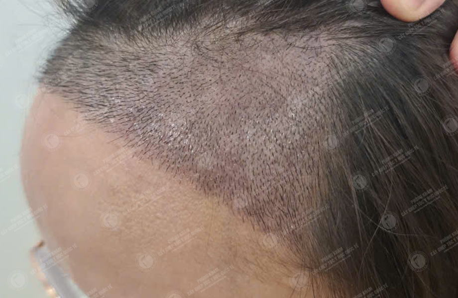 Phạm Thị Huệ - Cấy tóc đường chữ M 5