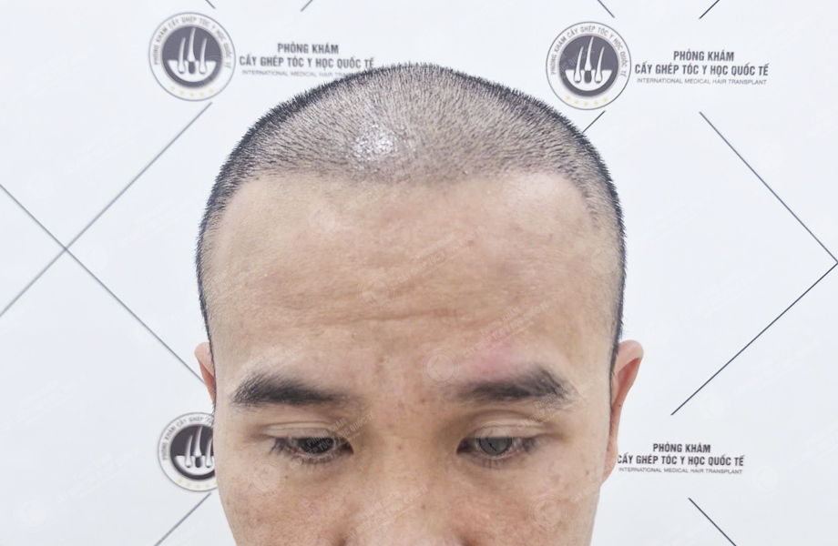 Phạm Đức Hùng - Cấy tóc đường chữ M 6