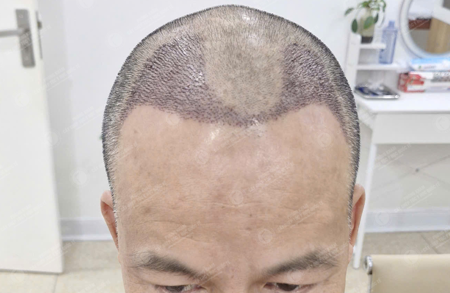 Trần Văn Toàn - Cấy tóc đường chữ M 6