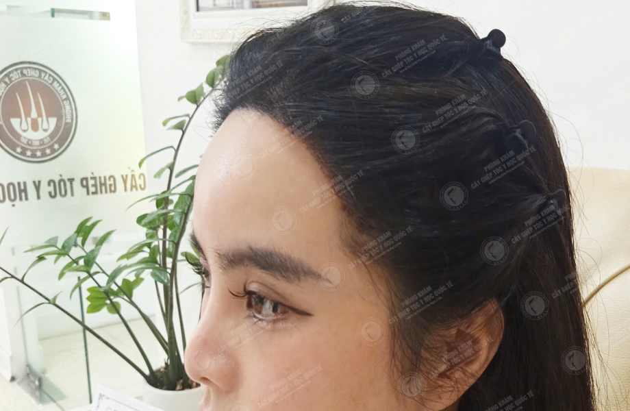 Huỳnh Bảo Ngân - Cấy tóc đường chữ M 6