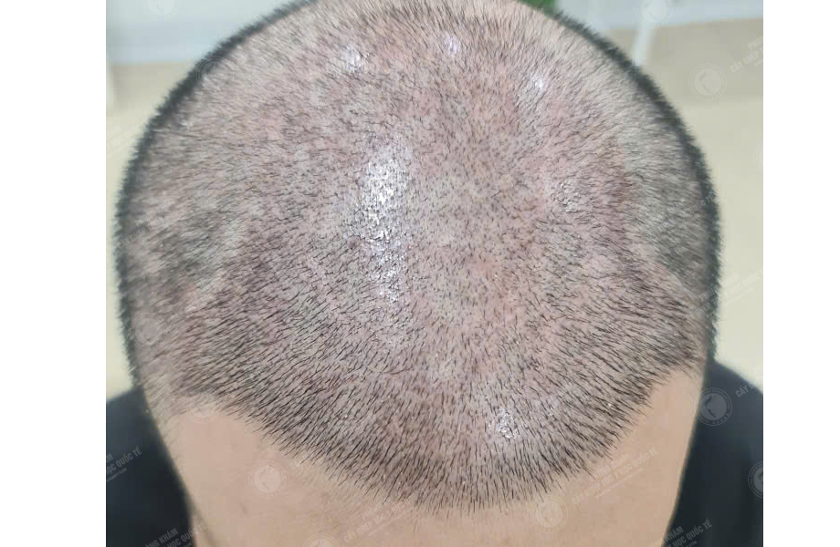 Nguyễn Văn Sơn - Cấy tóc đường chữ M 6