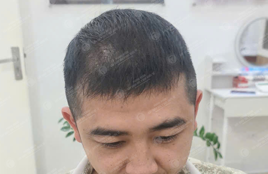 Lý Hoài Nam - Cấy tóc đường chữ M 6