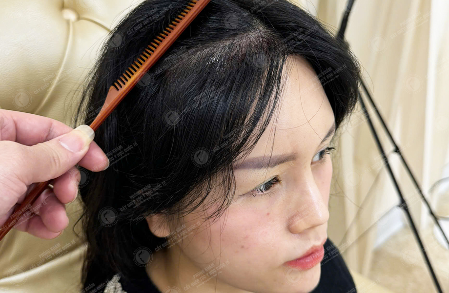 Nguyễn Thu Trà - Cấy tóc đường chữ M 6