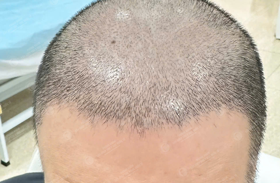 Nguyễn Duy Sơn - Cấy tóc đường chữ M 6