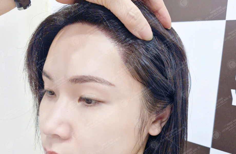 Hoàng Ngọc Linh - Cấy tóc đường chữ M 6
