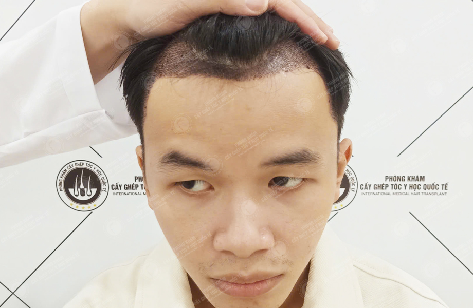 Trần Tuấn Hùng - Cấy tóc đường chữ M 6