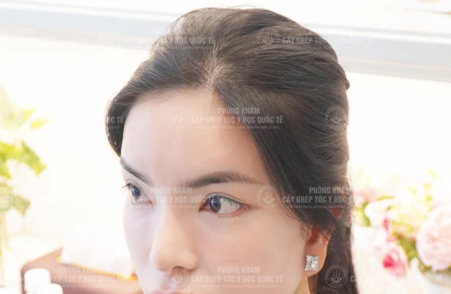 Đỗ Thanh Tuyền - Cấy tóc đường chữ M 6