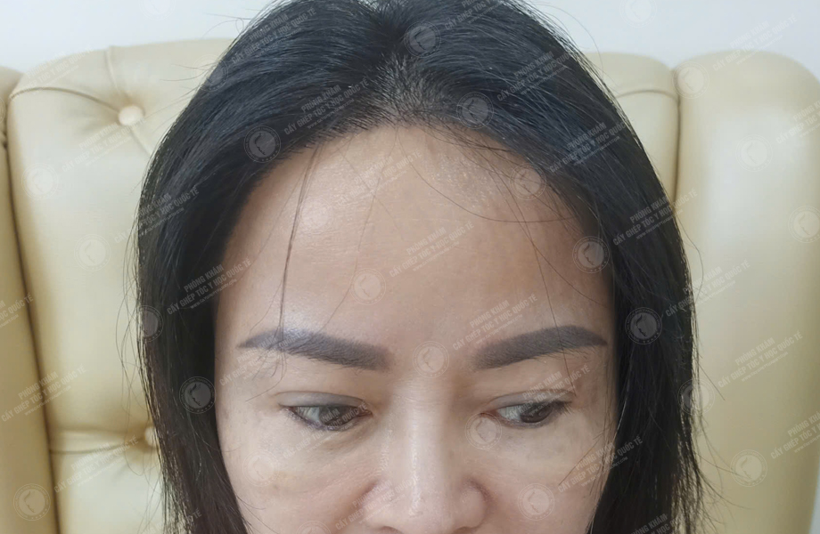 Nguyễn Thị Lan - Cấy tóc đường chữ M 6