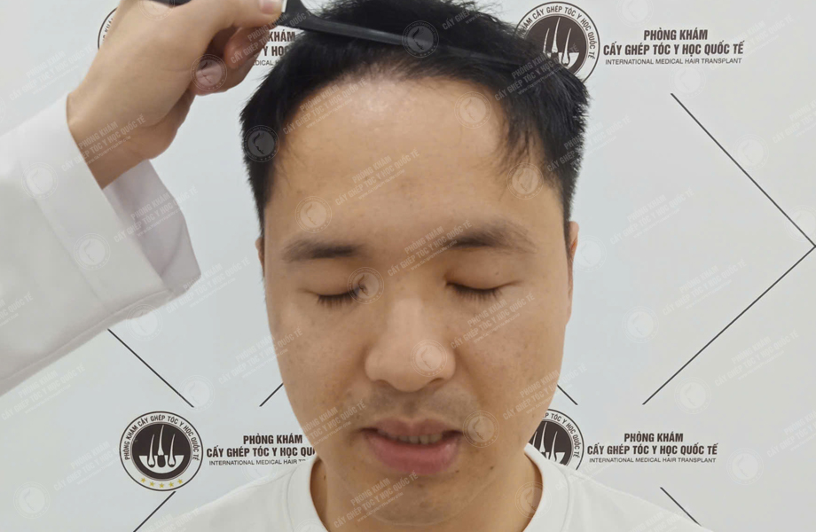 Nguyễn Văn Tùng - Cấy tóc đường chữ M 6