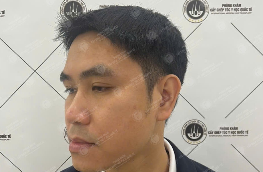 Nguyễn Văn Nam - Cấy tóc đường chữ M 6