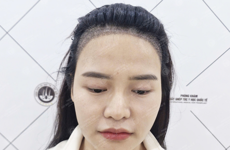 Phạm Thị Trang - Cấy tóc đường chữ M 6
