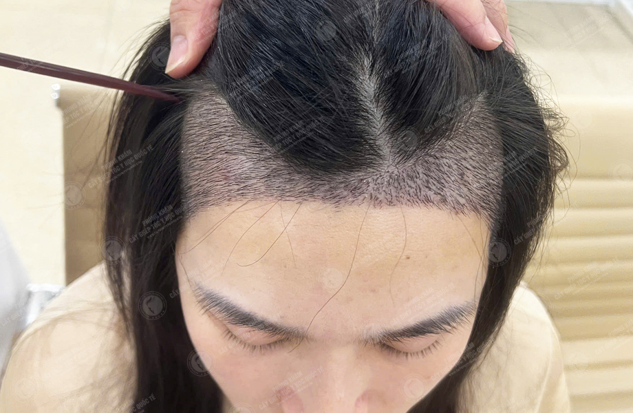 Lê Thị Nhi - Cấy tóc đường chữ M 6