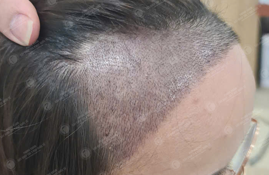 Phạm Thị Huệ - Cấy tóc đường chữ M 6