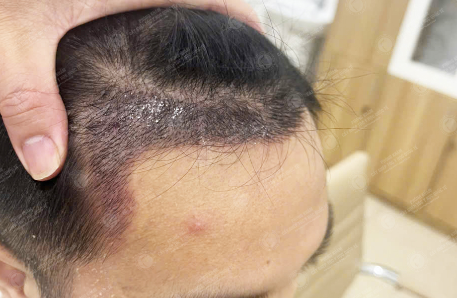 Phan Tùng Lâm - Cấy tóc đường chữ M 6