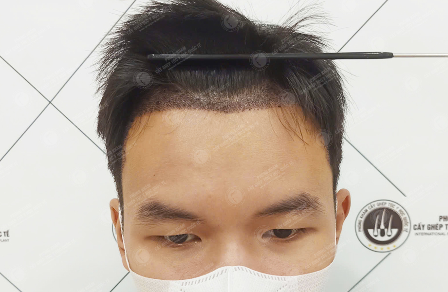 Trần Tuấn Hùng - Cấy tóc đường chữ M 7