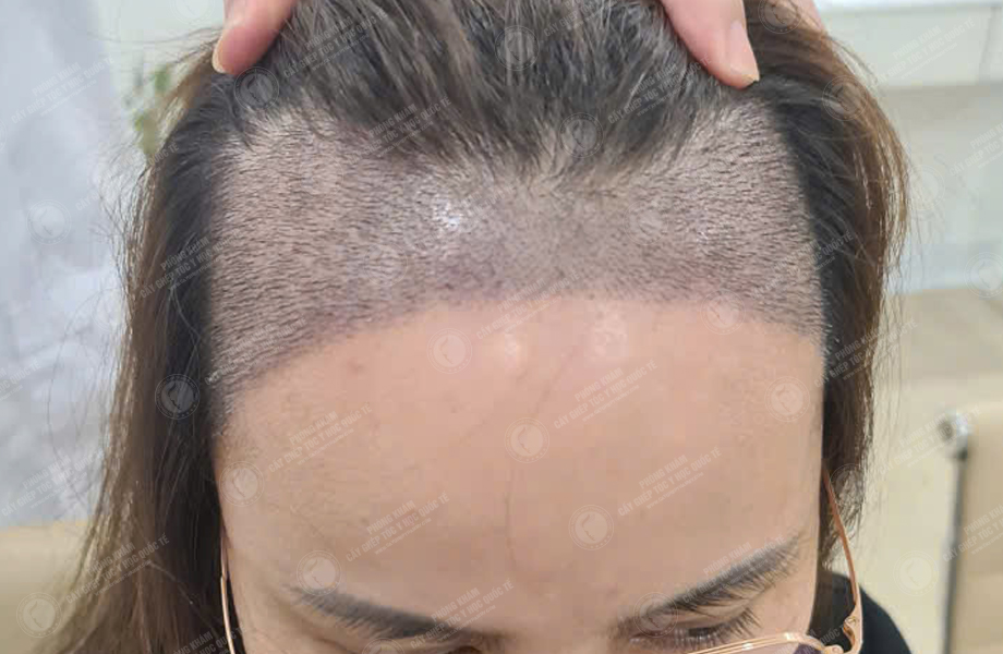 Phạm Thị Huệ - Cấy tóc đường chữ M 7