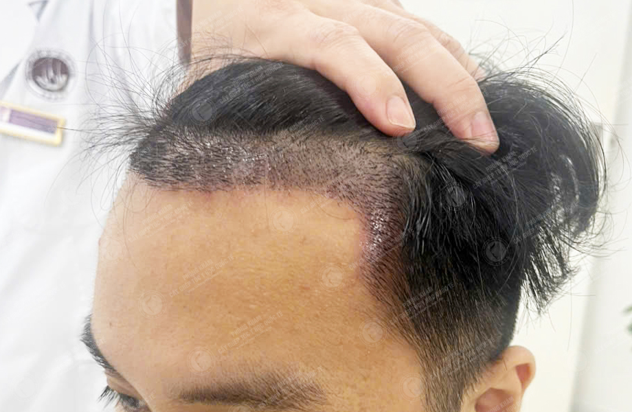 Phan Tùng Lâm - Cấy tóc đường chữ M 7