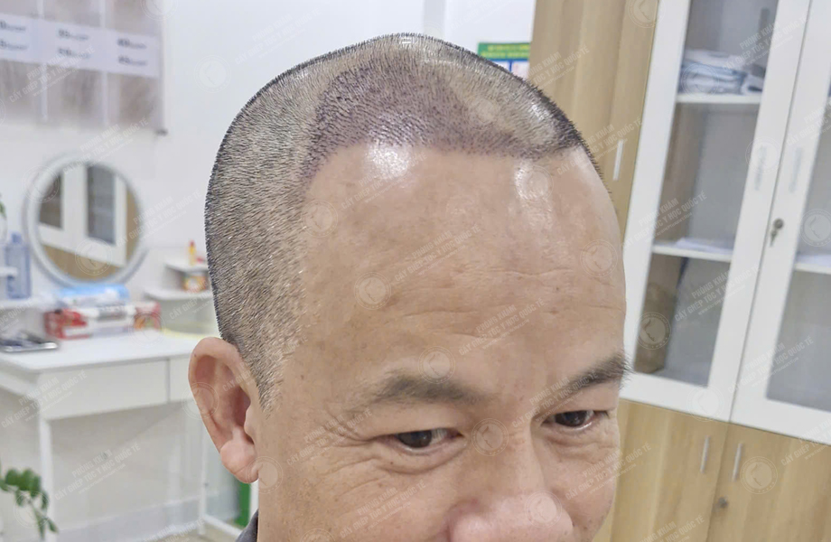 Trần Văn Toàn - Cấy tóc đường chữ M 7