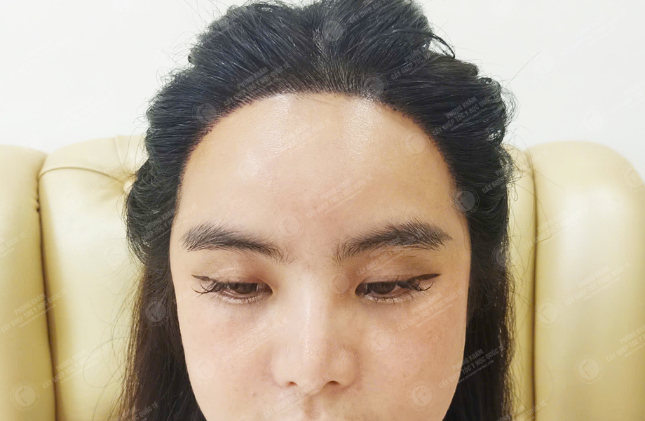 Huỳnh Bảo Ngân - Cấy tóc đường chữ M 7