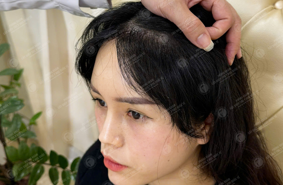 Nguyễn Thu Trà - Cấy tóc đường chữ M 7