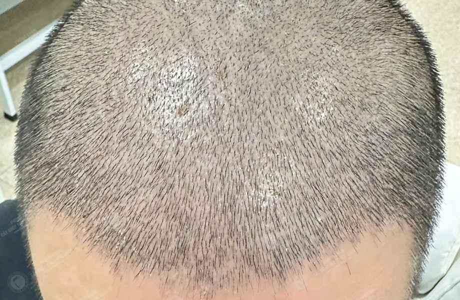 Nguyễn Duy Sơn - Cấy tóc đường chữ M 7
