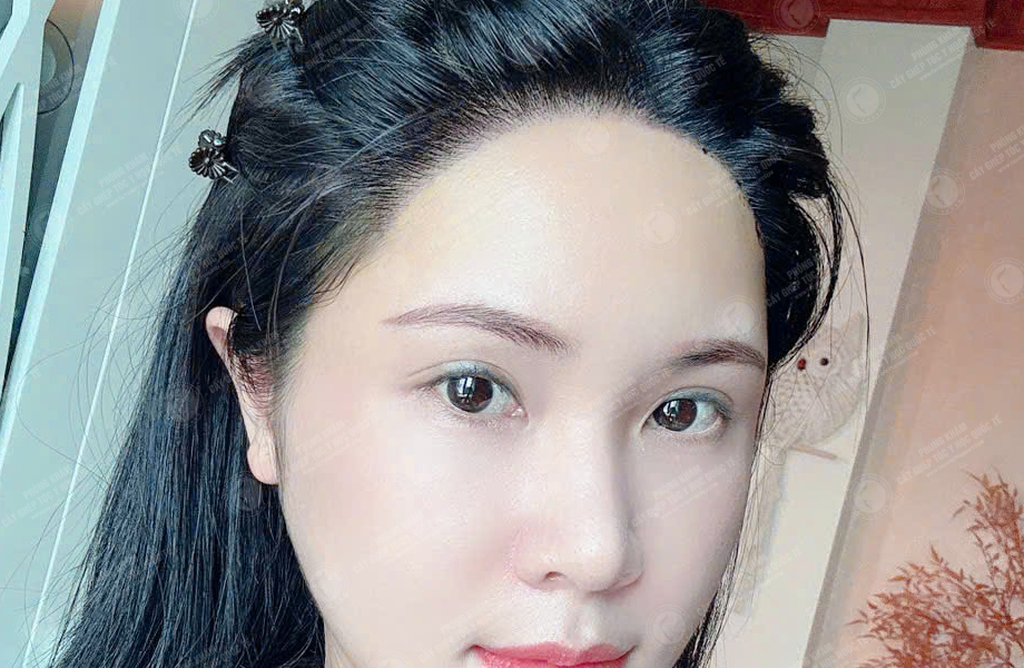 Hoàng Ngọc Linh - Cấy tóc đường chữ M 7