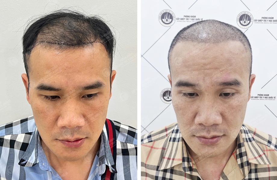  Phạm Đức Hùng - Cấy tóc đường chữ M 1