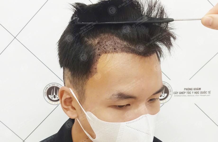 Trần Tuấn Hùng - Cấy tóc đường chữ M 8