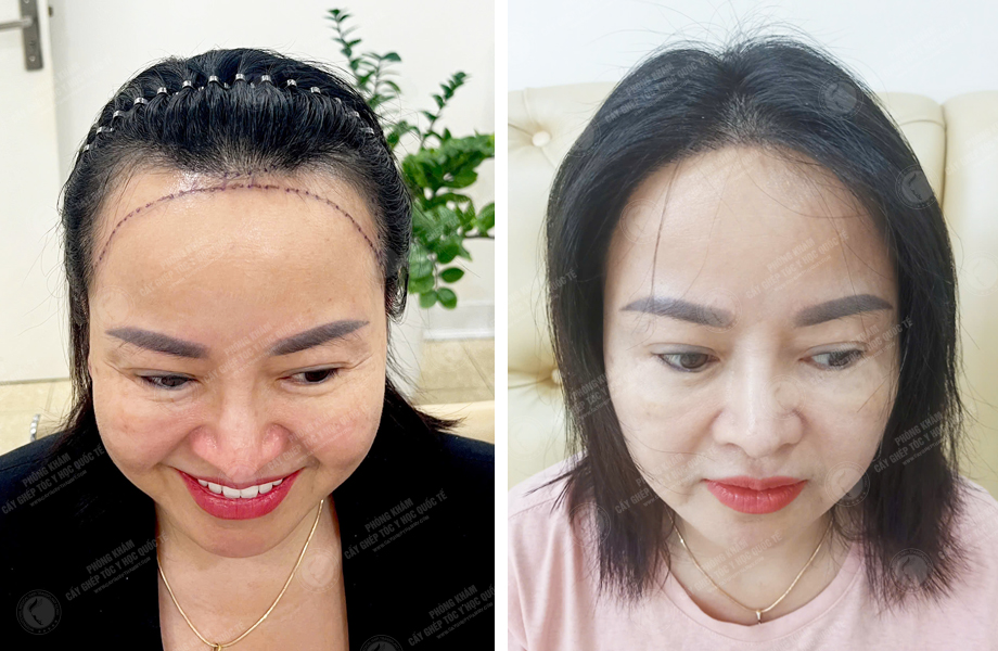  Nguyễn Thị Lan - Cấy tóc đường chữ M 1