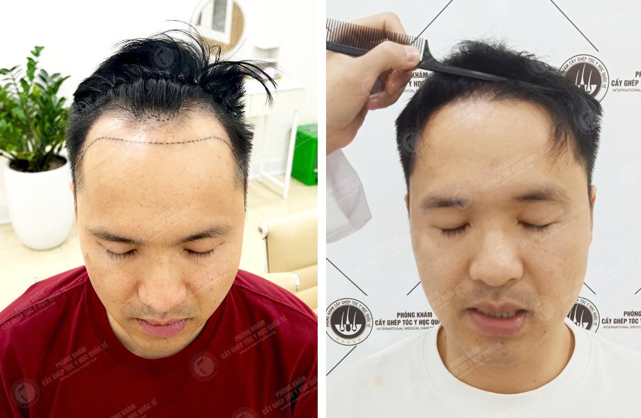  Nguyễn Văn Tùng - Cấy tóc đường chữ M 1