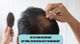 Cấy tóc vùng hói đỉnh đầu: Quy trình, chi phí và địa chỉ uy tín bạn nên biết