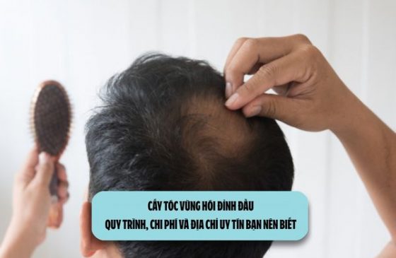 Cấy tóc vùng hói đỉnh đầu: Quy trình, chi phí và địa chỉ uy tín bạn nên biết