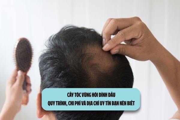 Cấy tóc vùng hói đỉnh đầu: Quy trình, chi phí và địa chỉ uy tín bạn nên biết