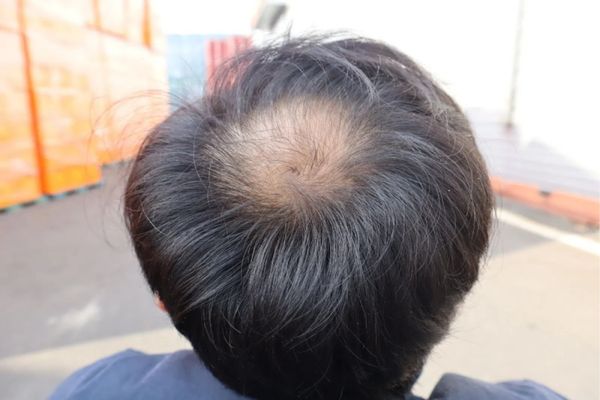 Cấy tóc vùng hói đỉnh đầu: Quy trình, chi phí và địa chỉ uy tín bạn nên biết