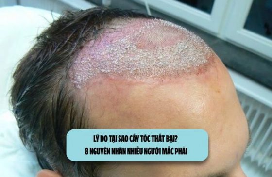 Lý do tại sao cấy tóc thất bại? 8 nguyên nhân nhiều người mắc phải