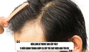 Nên làm gì trước khi cấy tóc? 9 điều quan trọng giúp ca cấy tóc đạt hiệu quả tối ưu