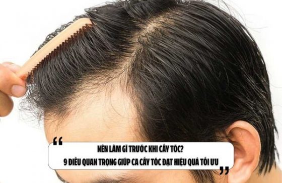 Nên làm gì trước khi cấy tóc? 9 điều quan trọng giúp ca cấy tóc đạt hiệu quả tối ưu