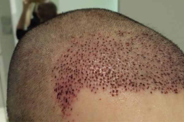 Nhiễm trùng sau khi cấy tóc: Dấu hiệu nhận biết và cách xử lý an toàn