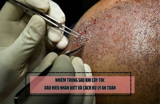 Nhiễm trùng sau khi cấy tóc: Dấu hiệu nhận biết và cách xử lý an toàn