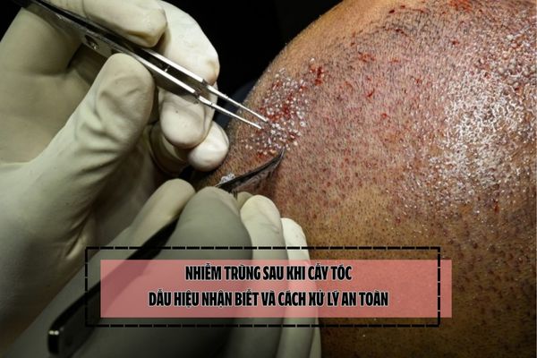 Nhiễm trùng sau khi cấy tóc: Dấu hiệu nhận biết và cách xử lý an toàn