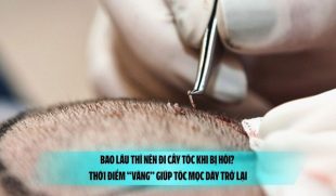 Bao lâu thì nên đi cấy tóc khi bị hói? Thời điểm “vàng” giúp tóc mọc dày trở lại