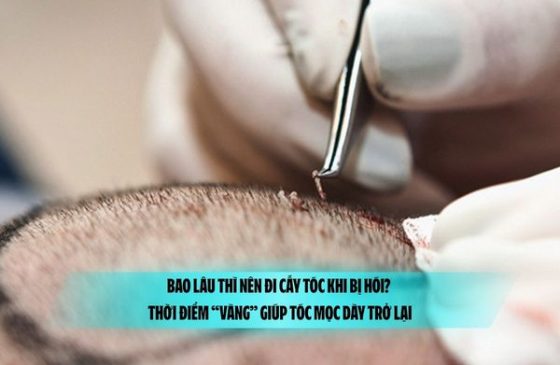 Bao lâu thì nên đi cấy tóc khi bị hói? Thời điểm “vàng” giúp tóc mọc dày trở lại
