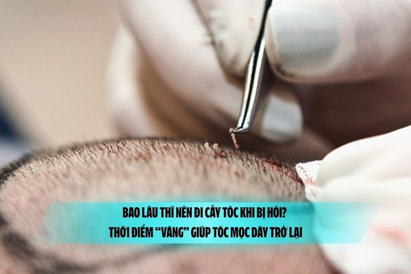 Bao lâu thì nên đi cấy tóc khi bị hói? Thời điểm “vàng” giúp tóc mọc dày trở lại