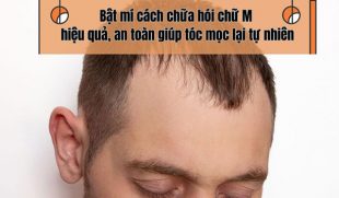 Bật mí cách chữa hói chữ M hiệu quả, an toàn giúp tóc mọc lại tự nhiên