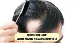 Bị hói chữ M nên làm gì? Giải pháp đúng theo từng giai đoạn từ chuyên gia