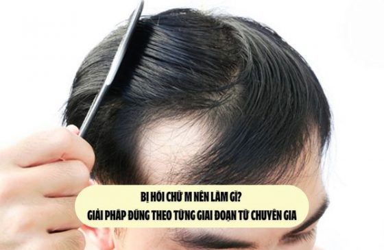 Bị hói chữ M nên làm gì? Giải pháp đúng theo từng giai đoạn từ chuyên gia