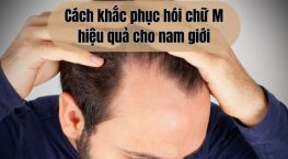TOP 3 Cách khắc phục hói chữ M hiệu quả cho nam giới