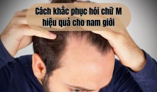 TOP 3 Cách khắc phục hói chữ M hiệu quả cho nam giới