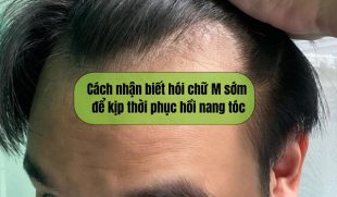 Cách nhận biết hói chữ M sớm để kịp thời phục hồi nang tóc
